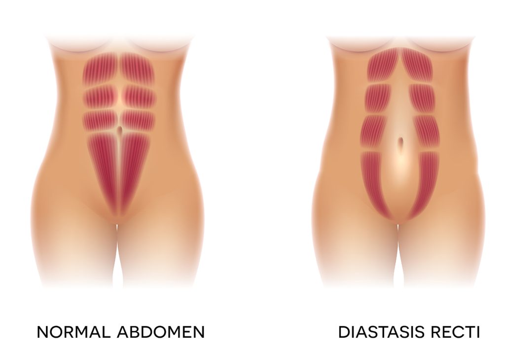 What is Diastasis recti? Post Pregnancy Tummy Tuck Surgery India