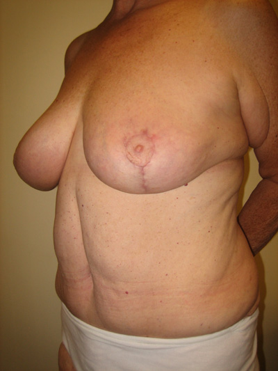 Plastic Surgery After Weight Loss on Long Island