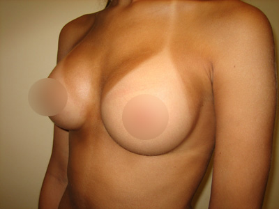 Breast implants on Long Island