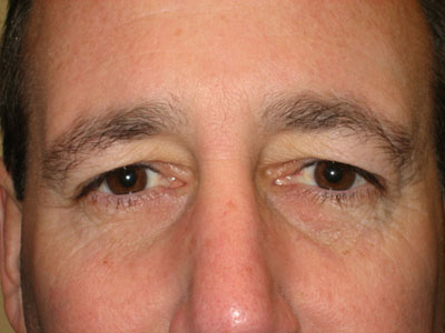 Eyelid surgery for men on Long Island & NYC
