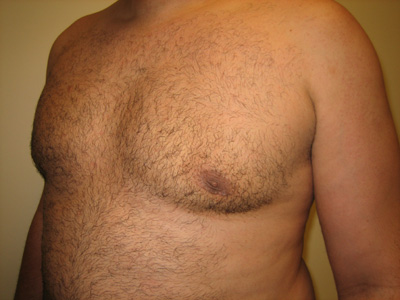 Male breast reduction on Long Island