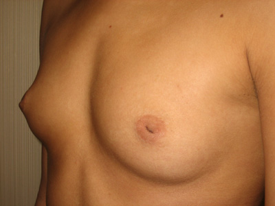 Inverted nipple correction on Long Island & NYC