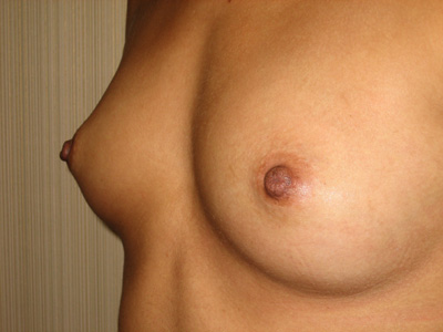 Inverted nipple repair on Long Island