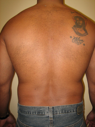 Liposuction for men on Long Island & NYC