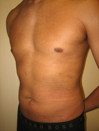 Liposuction on Long Island