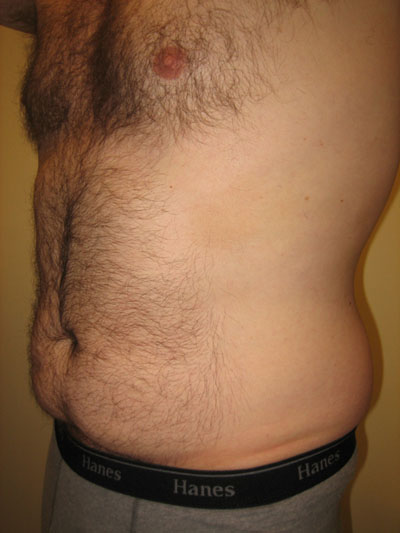Tummy tuck for men on Long Island & NYC