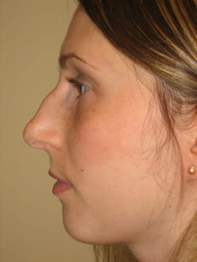 Nose surgery on Long Island & NYC
