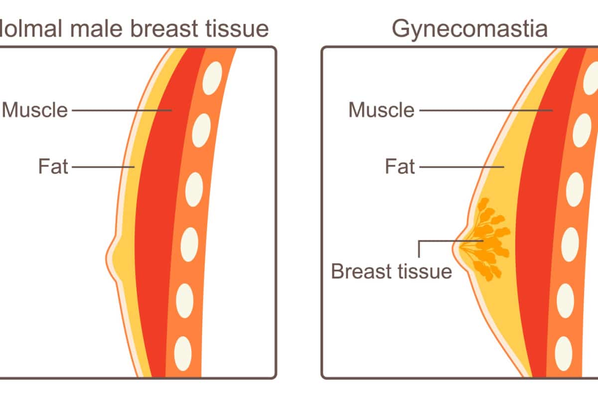 Unilateral vs. Bilateral Gynecomastia: Understanding the Key Differentiators