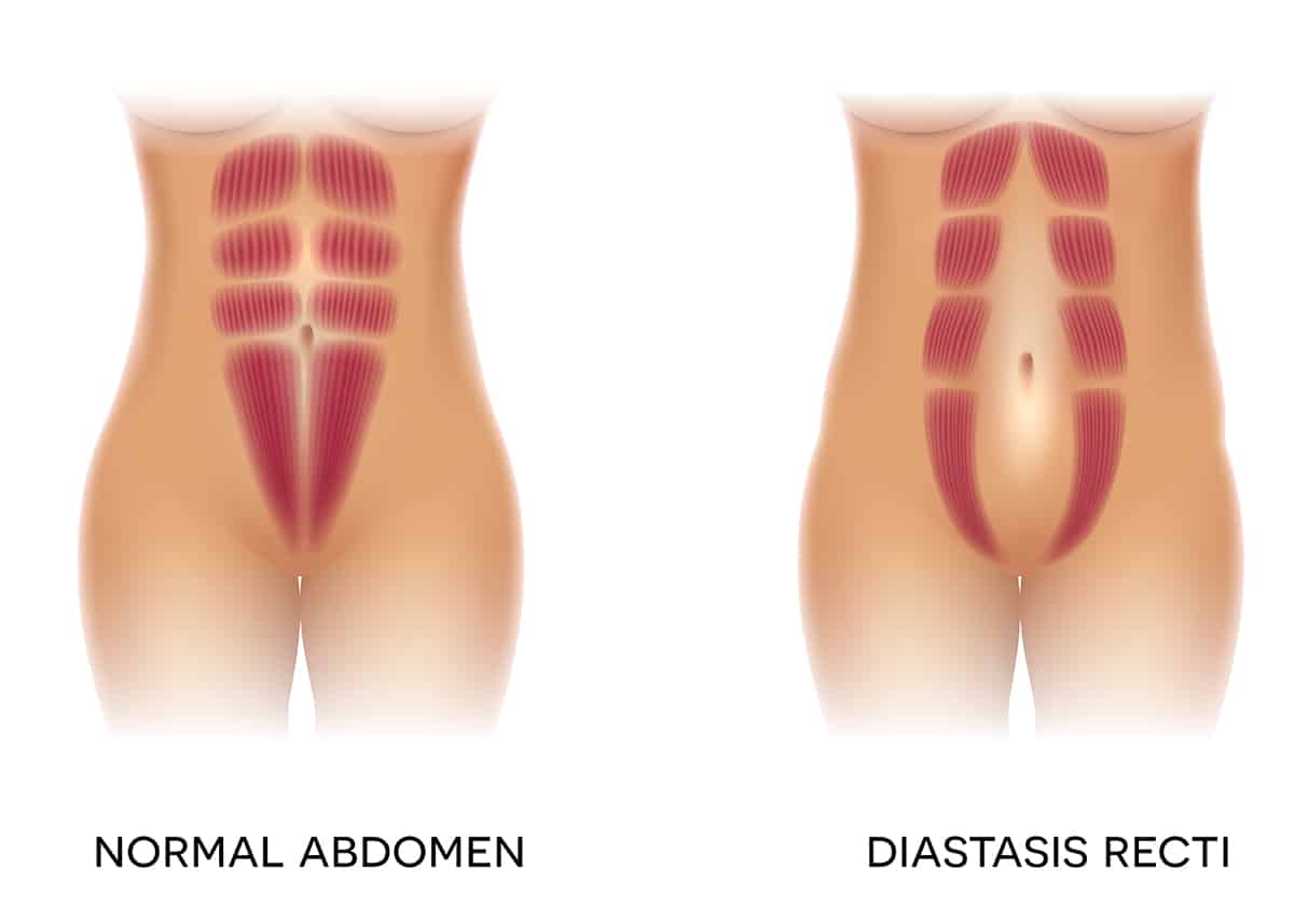 Will Tummy Tuck Fix Diastasis Recti After Pregnancy?