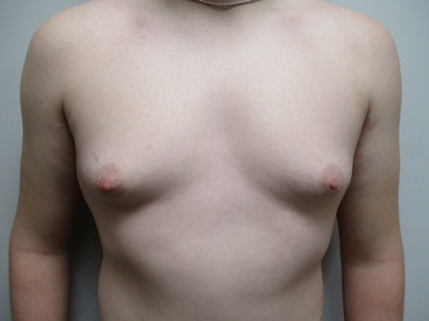 Before Image: Patient 19700 - front