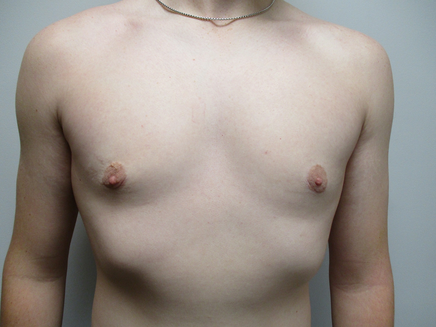 After Image: Patient 19700 - front