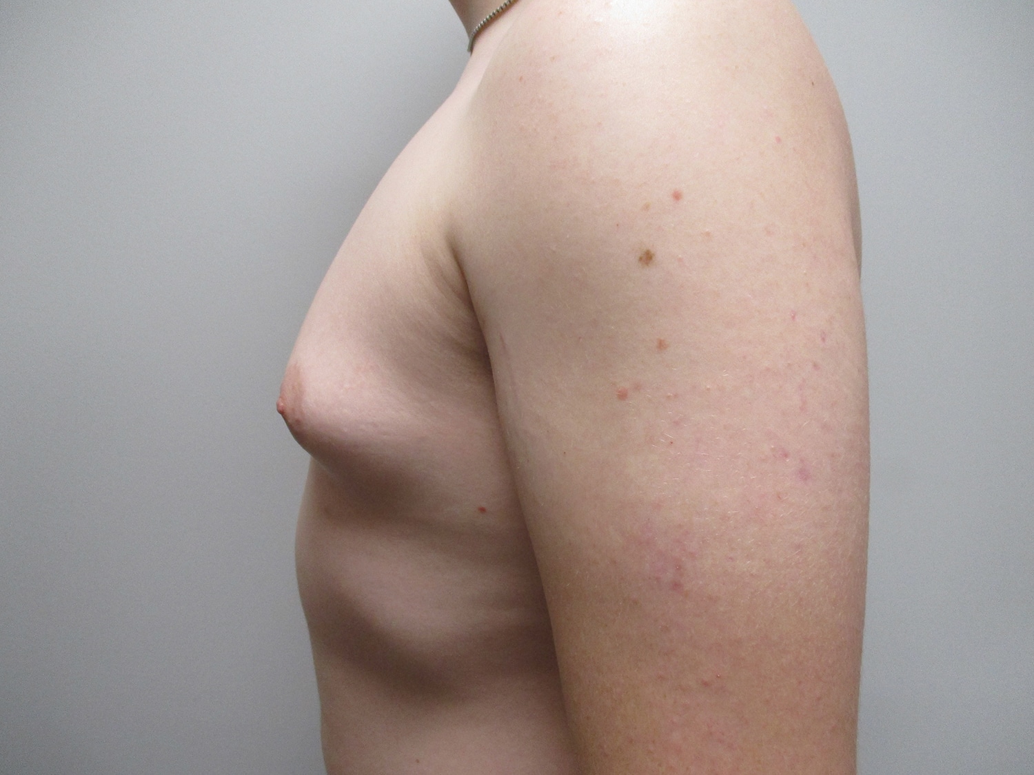 Before Image: Patient 19700 - left-side