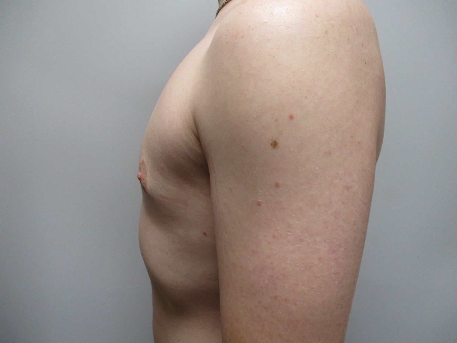 After Image: Patient 19700 - left-side