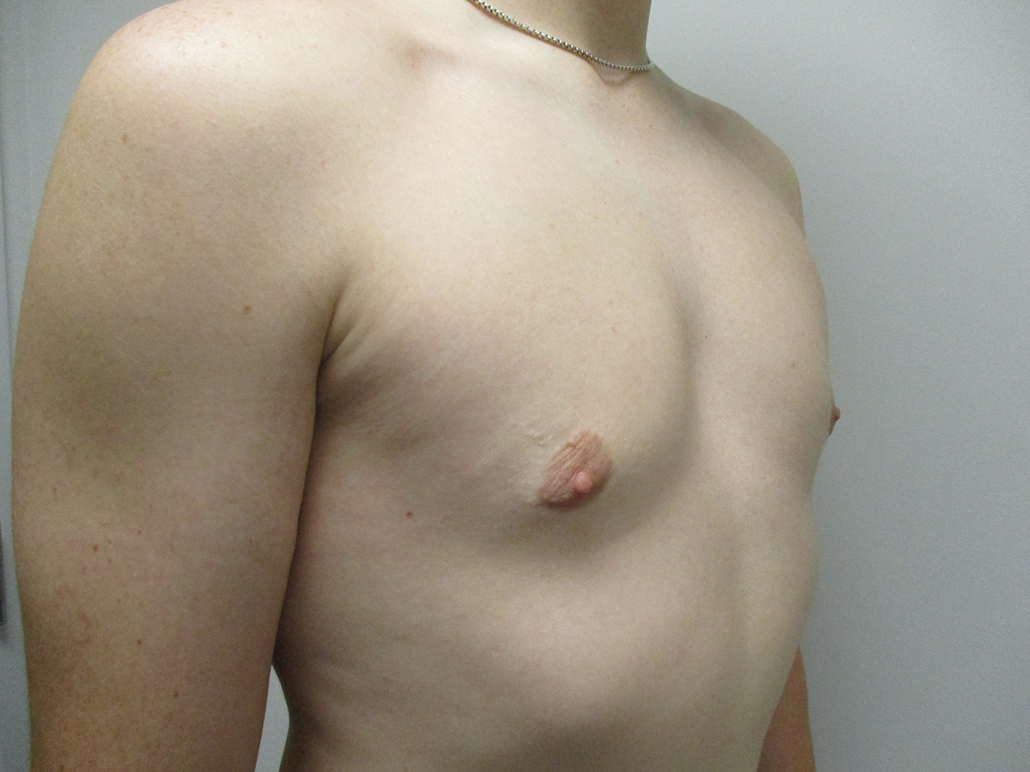 After Image: Patient 19700 - right-front-oblique