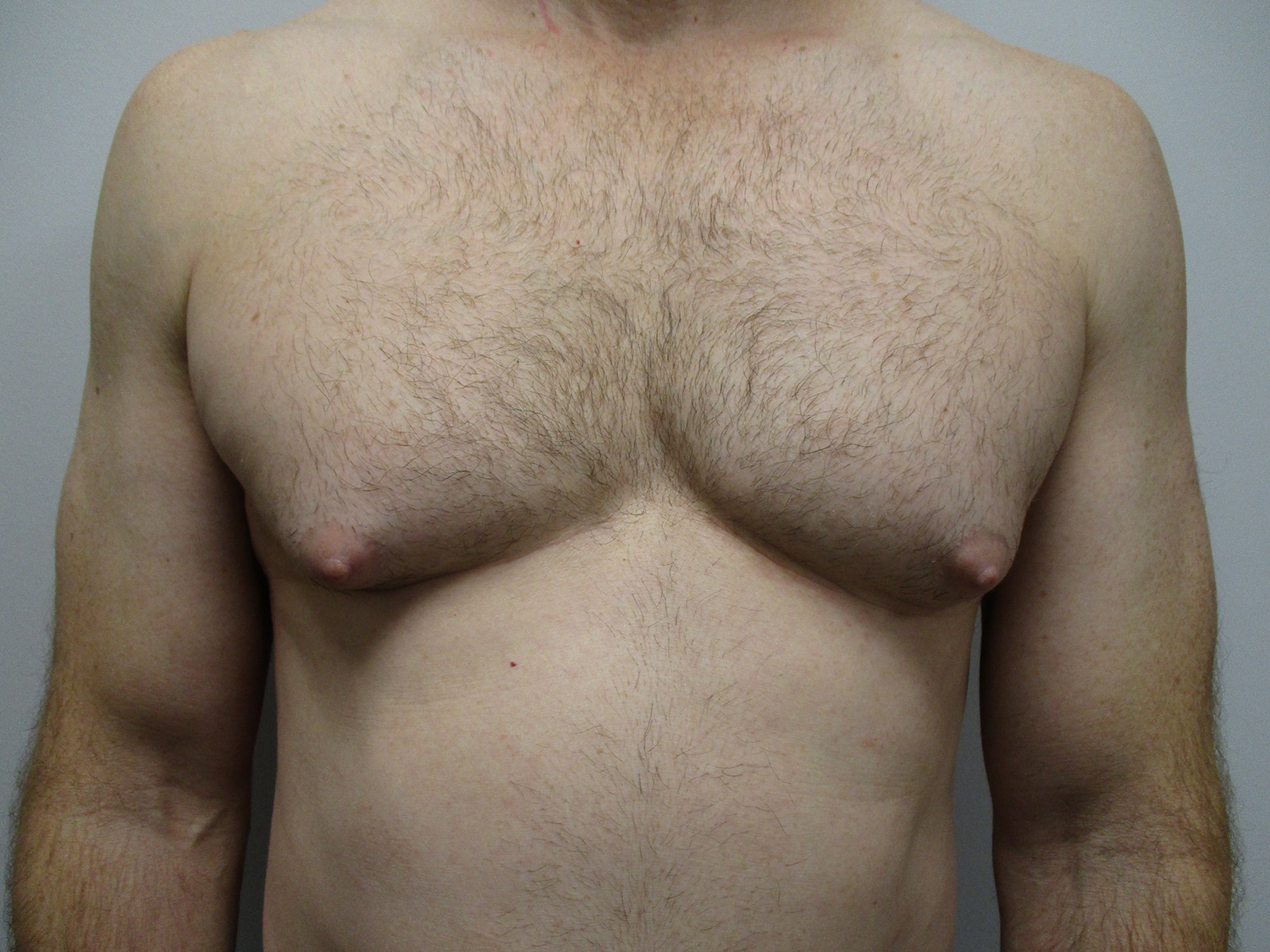 Before Image: Patient 20461 - front