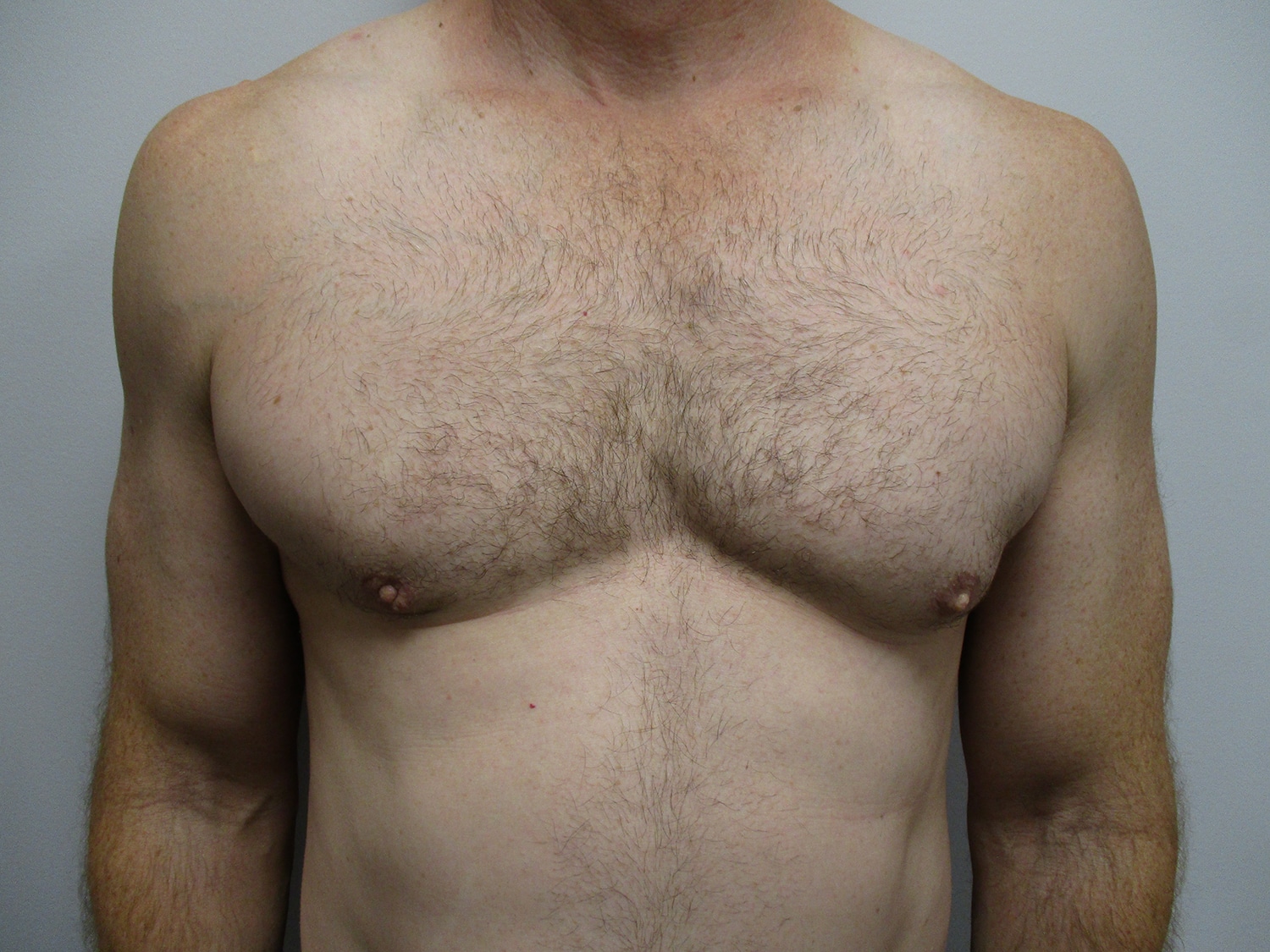 After Image: Patient 20461 - front