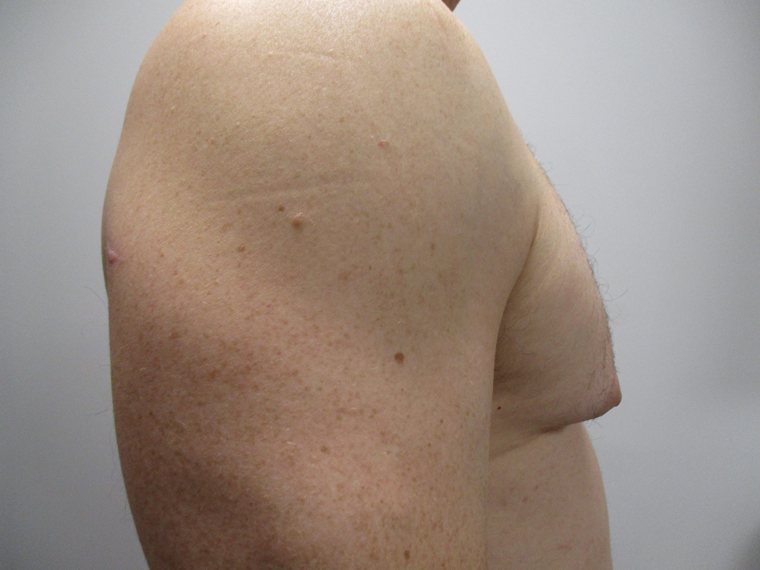 Before Image: Patient 20461 - right-side