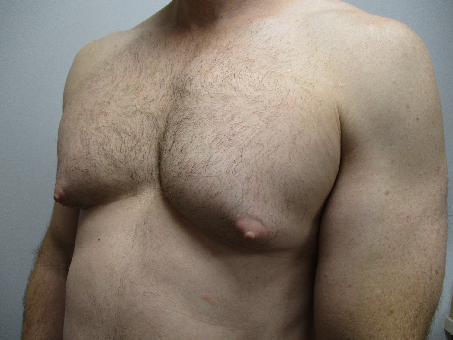 Before Image: Patient 20461 - left-front-oblique