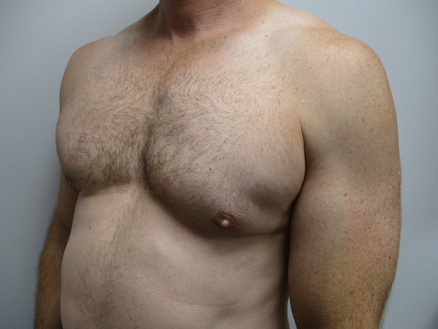 After Image: Patient 20461 - left-front-oblique