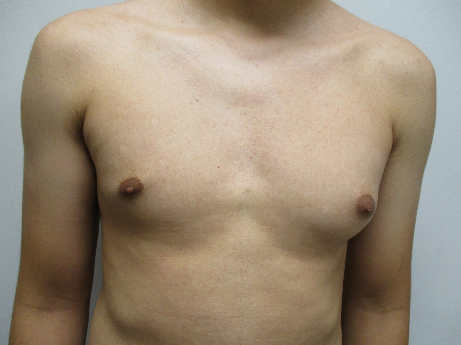 Before Image: Patient 21302 - front