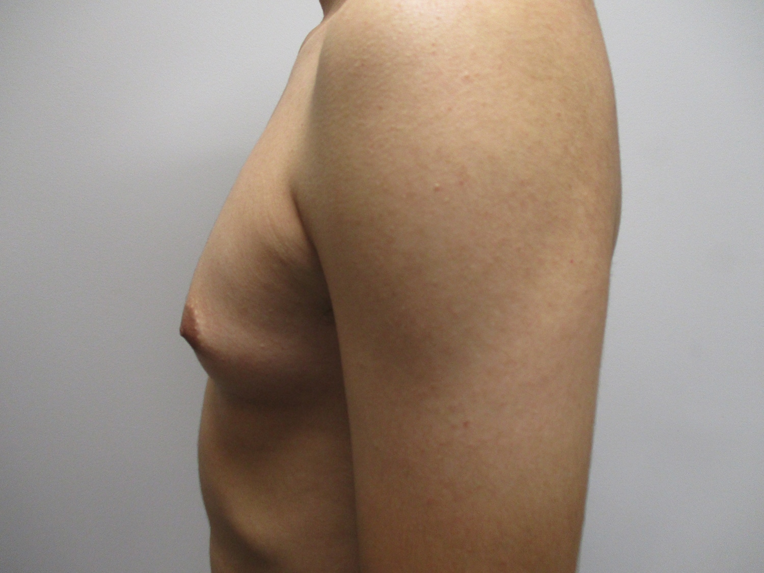 Before Image: Patient 21302 - left-side