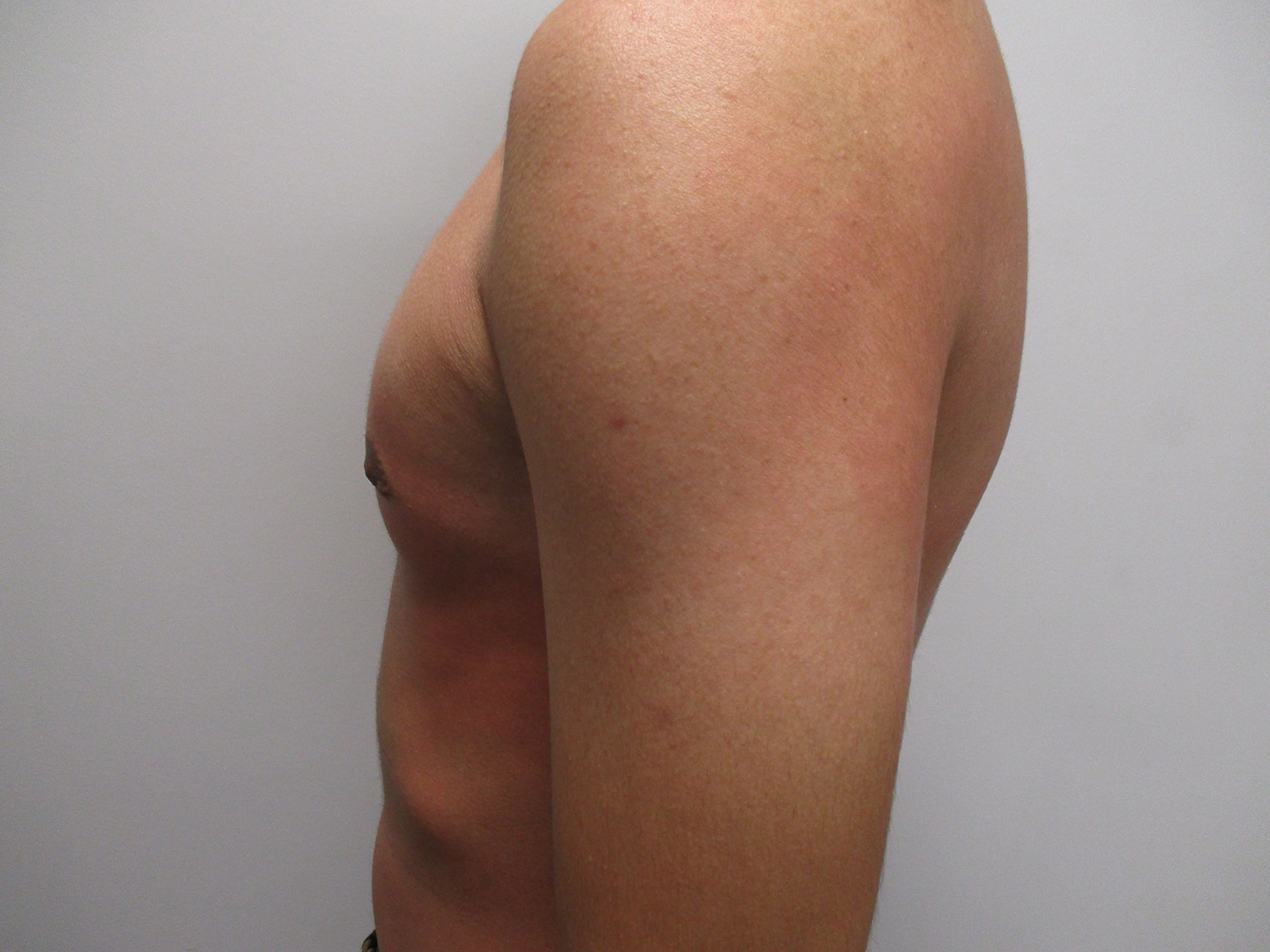 After Image: Patient 21302 - left-side
