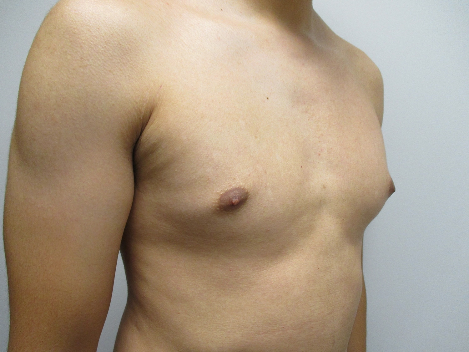 Before Image: Patient 21302 - right-front-oblique