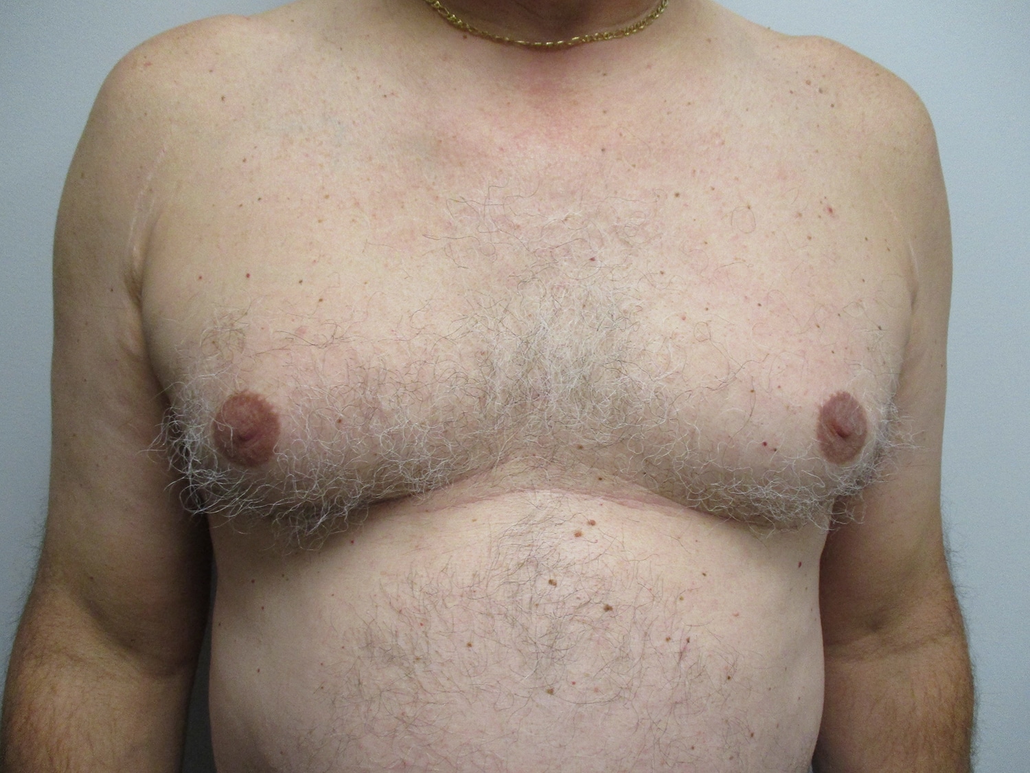 Before Image: Patient 21349 - front