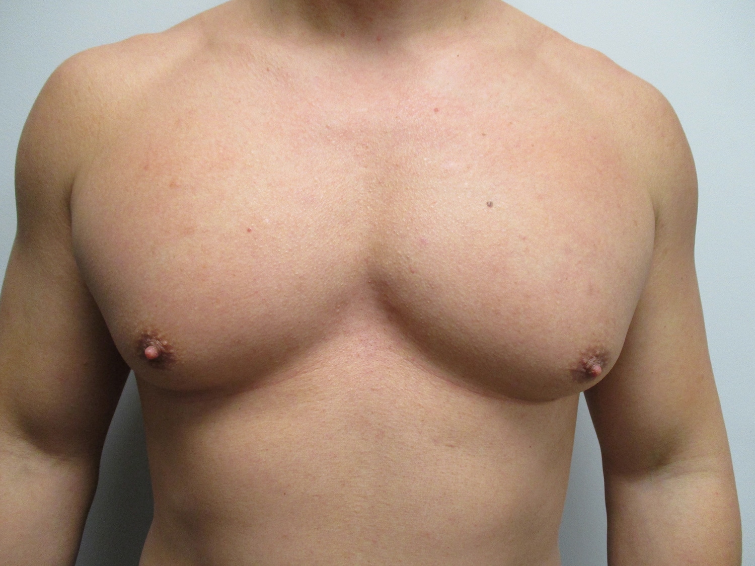 Before Image: Patient 21351 - front