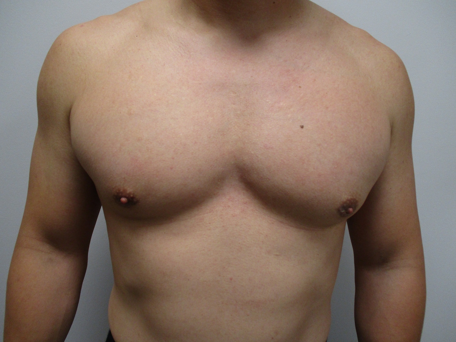 After Image: Patient 21351 - front