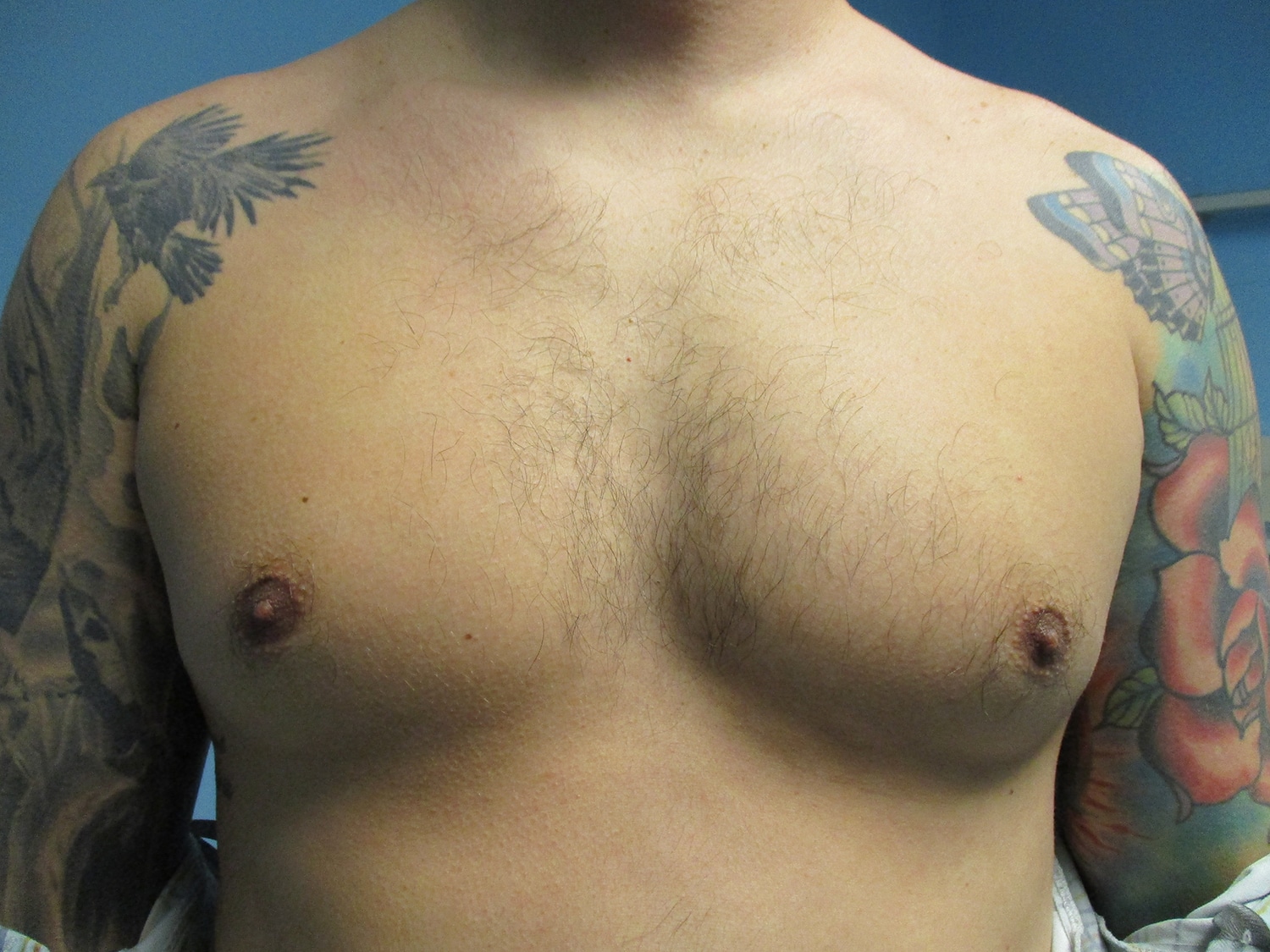 Before Image: Patient 21393 - front