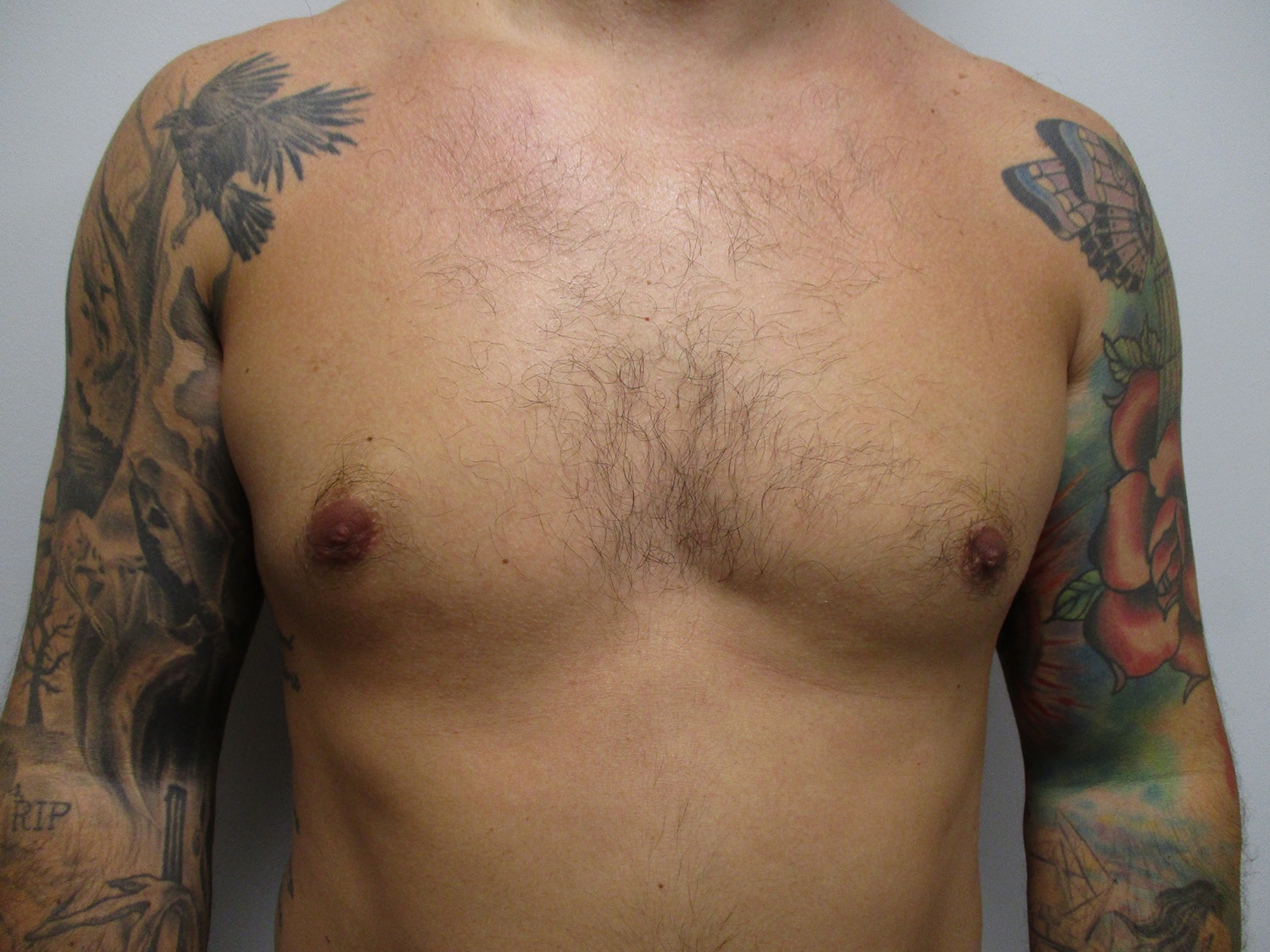After Image: Patient 21393 - front