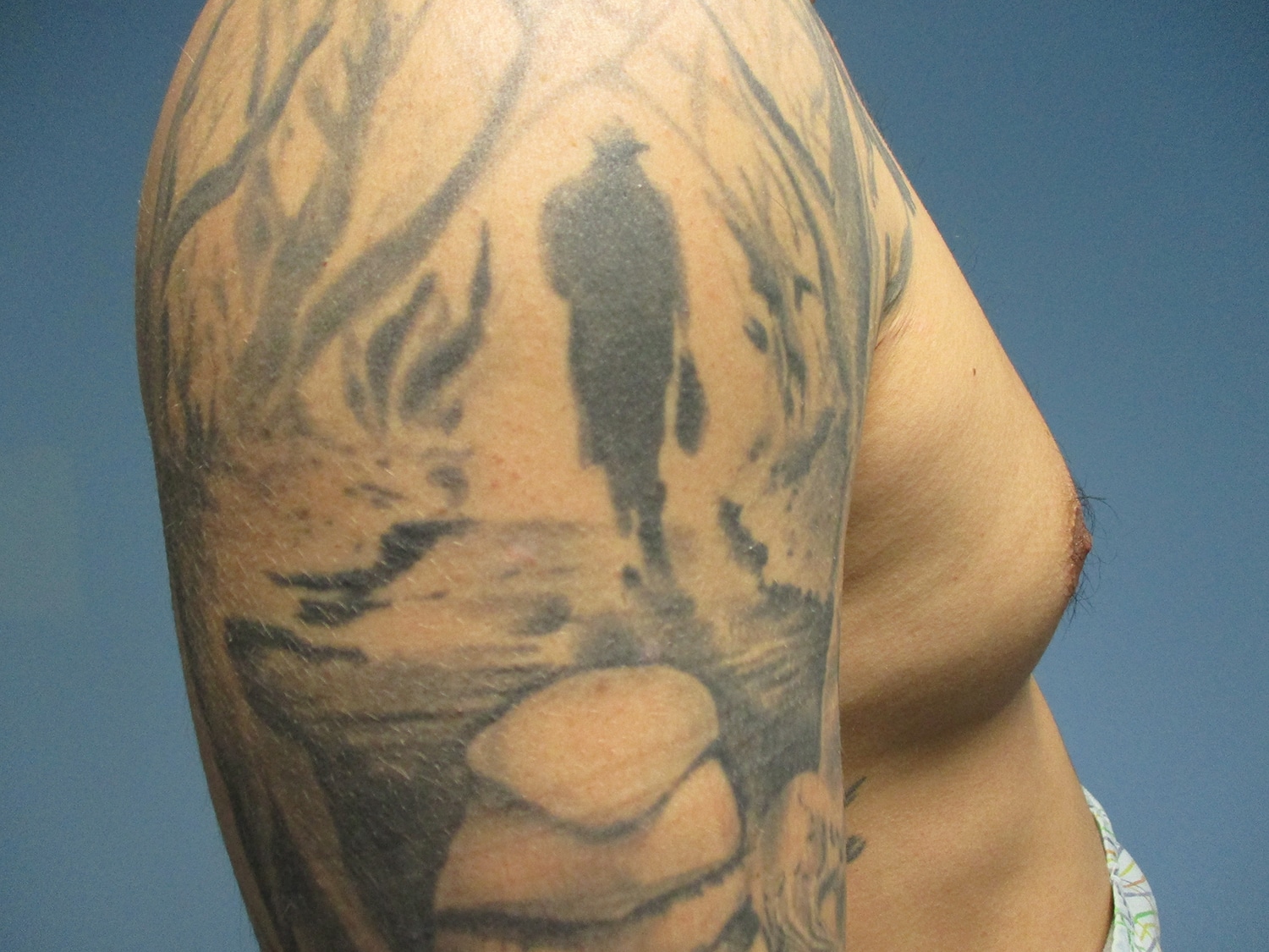 Before Image: Patient 21393 - right-side