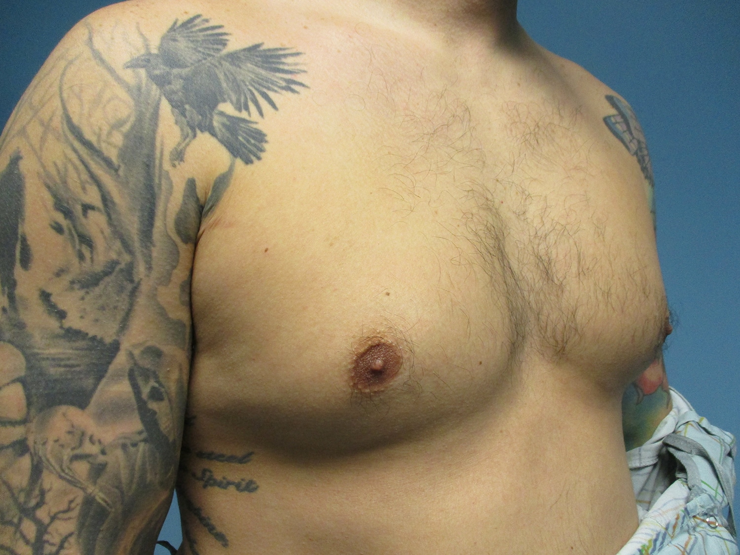 Before Image: Patient 21393 - right-front-oblique