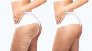 Cellulaze in Manhattan