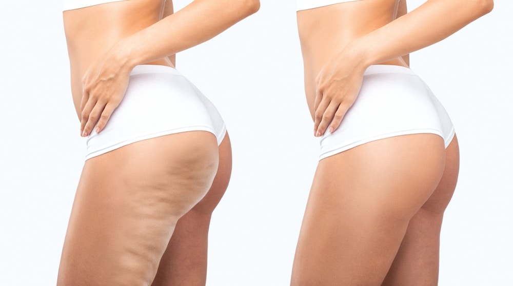 Cellulaze in Manhattan