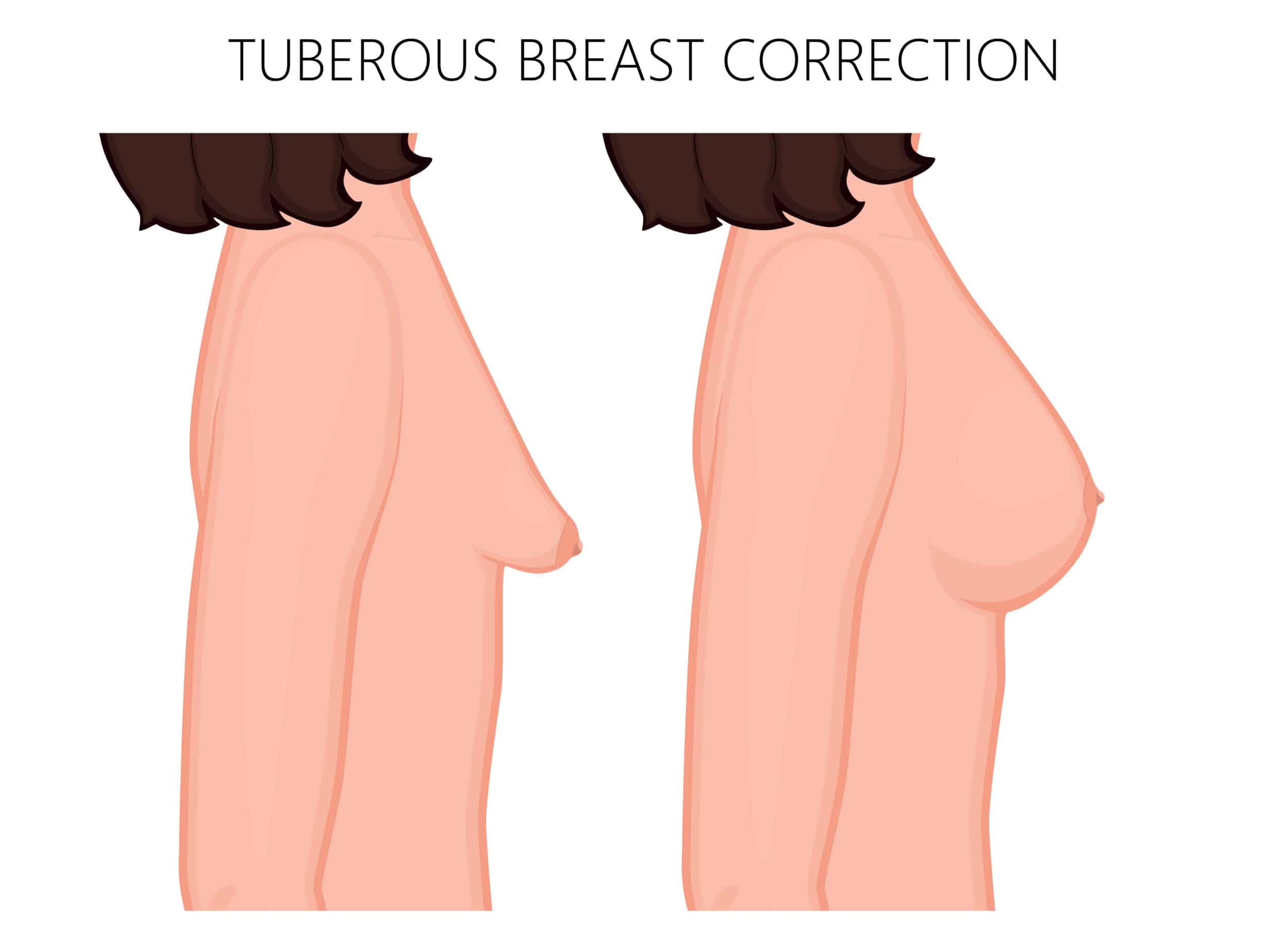 Artist's depiction of tubular breasts, showing elongated, hanging breast tissue