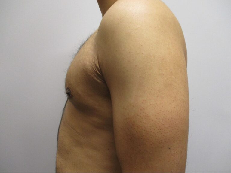 After Image: Patient 21753 - left-side