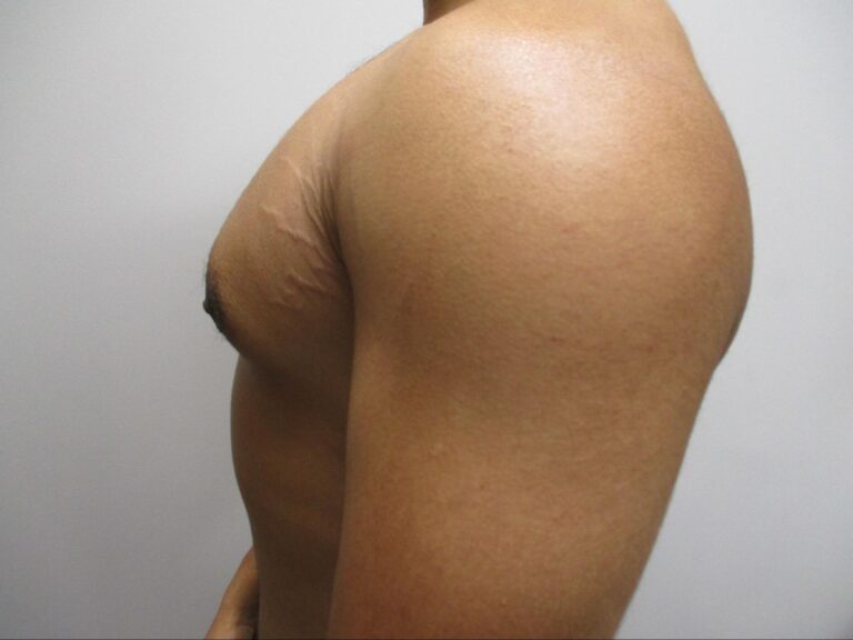 After Image: Patient 21839 - left-side