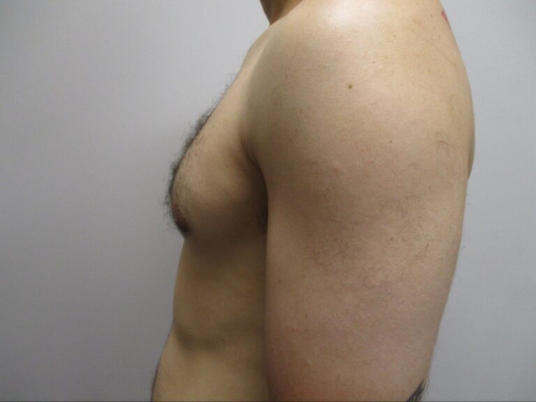 After Image: Patient 22123 - left-side