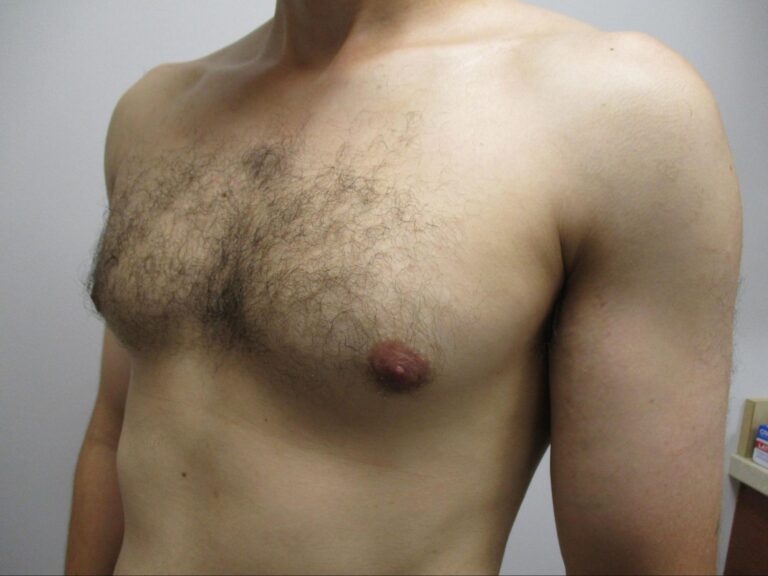 After Image: Patient 22123 - left-front-oblique