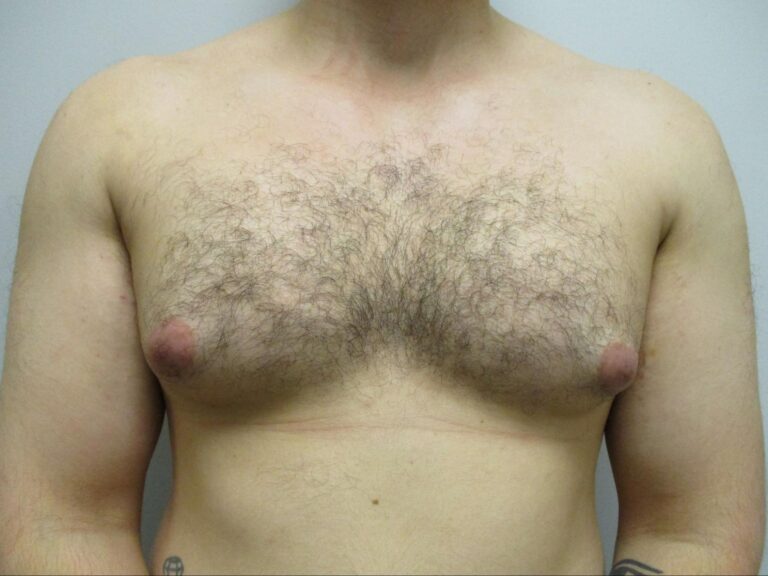 Before Image: Patient 22123 - front