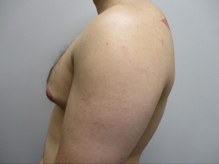 Before Image: Patient 22123 - left-side
