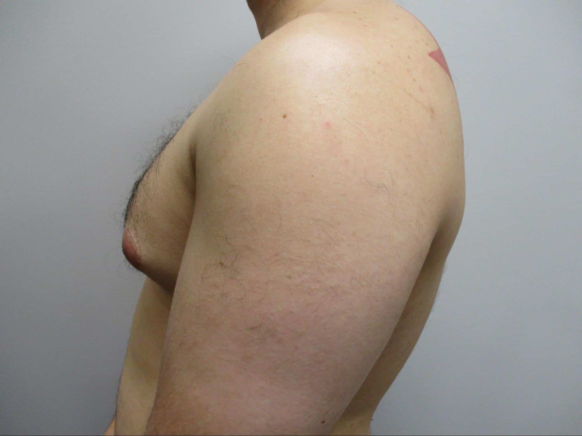 Before Image: Patient 22123 - left-side