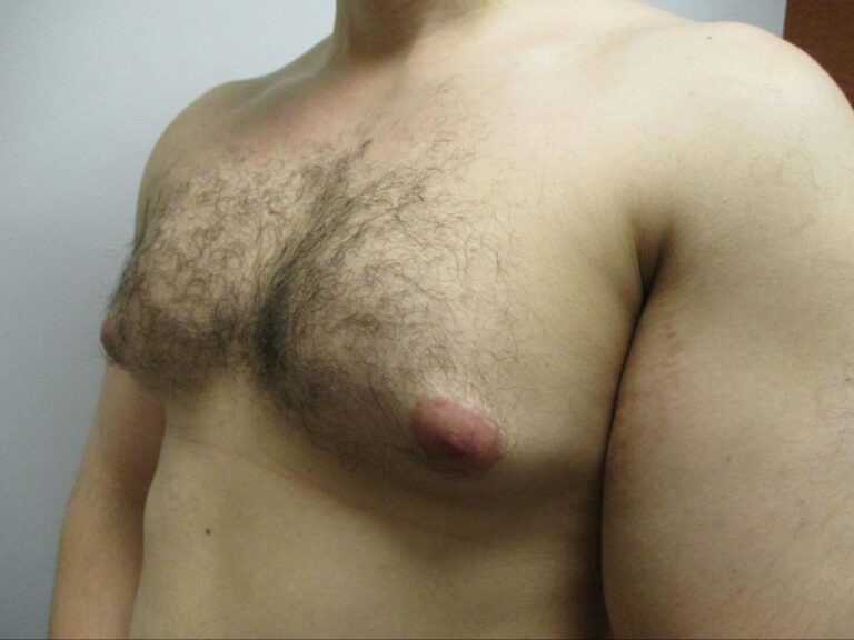 Before Image: Patient 22123 - left-front-oblique
