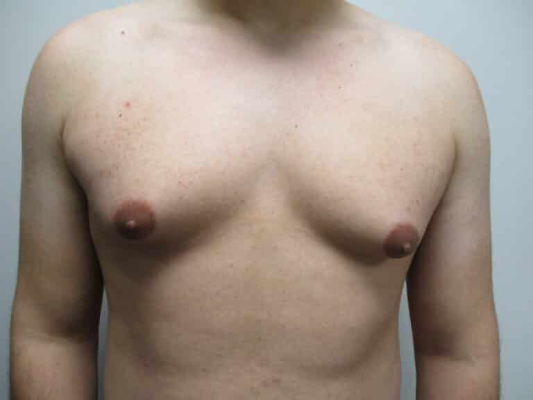 Before Image: Patient 21749 - front