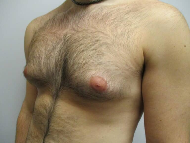 Before Image: Patient 22908 - left-front-oblique