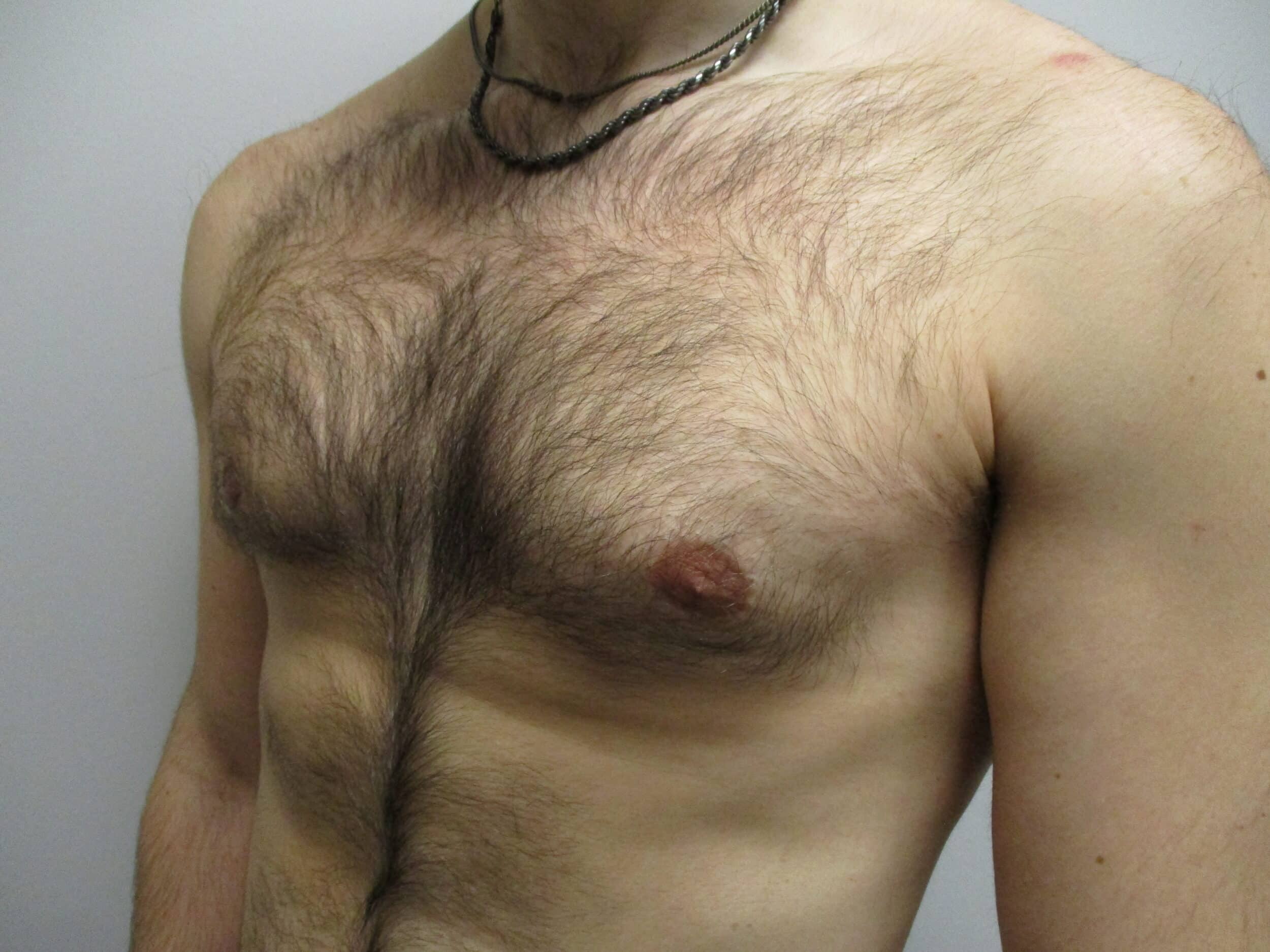 After Image: Patient 22908 - left-front-oblique