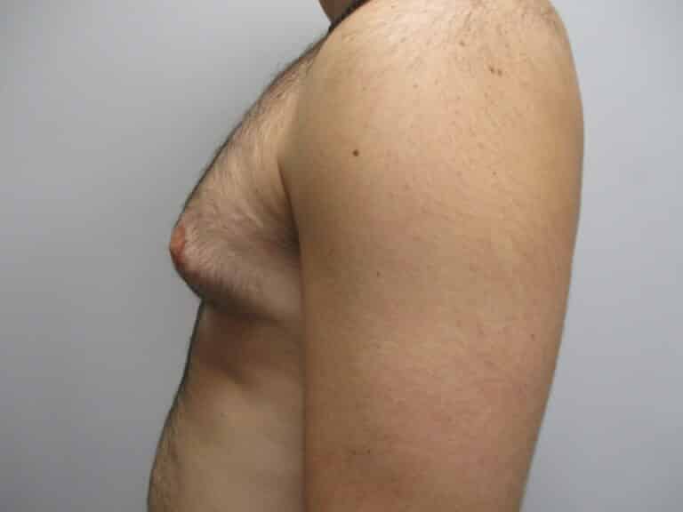 Before Image: Patient 22908 - left-side