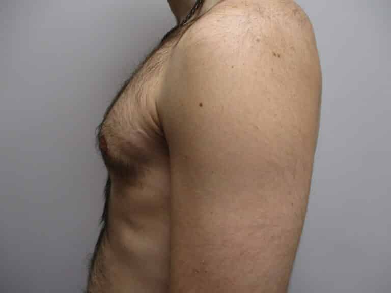After Image: Patient 22908 - left-side